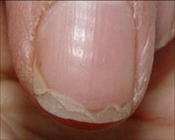 При чупливи нокти най-добре е да потърсите помощта на дерматолог
