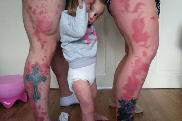 Родителите на това момиченце решават да си татуират същите петна по краката, като родилните петна на дъщеря си, за да не се чувства тя различна