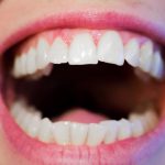 избелване на зъбите